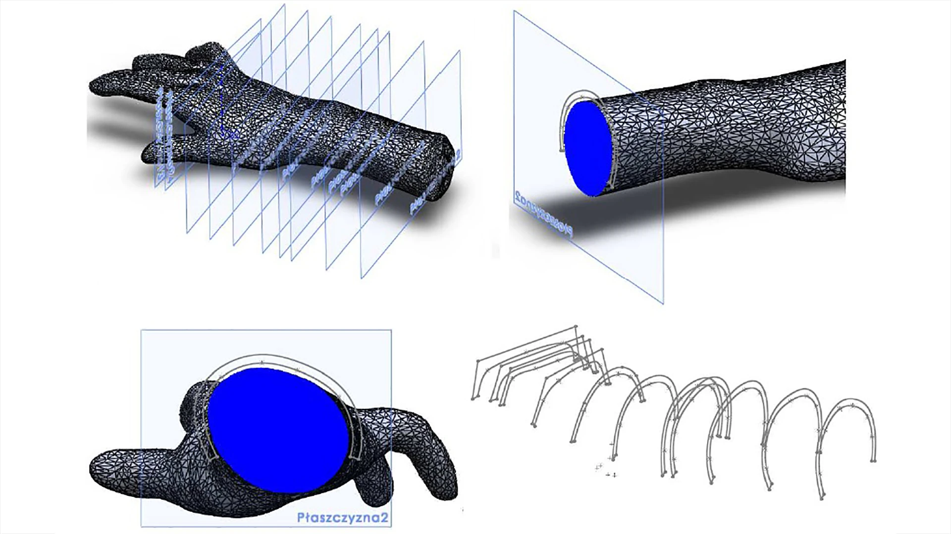 The researchers set about tackling the problem by making a plaster cast of the patient's right hand, and then using it to create a detailed 3D model