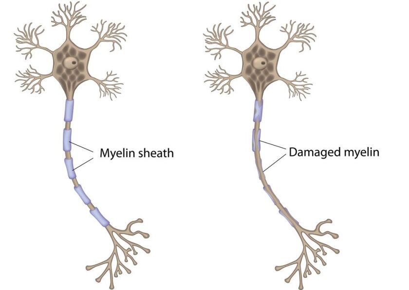 A normal nerve cell (left) and one affected by MS (Image: Shutterstock)