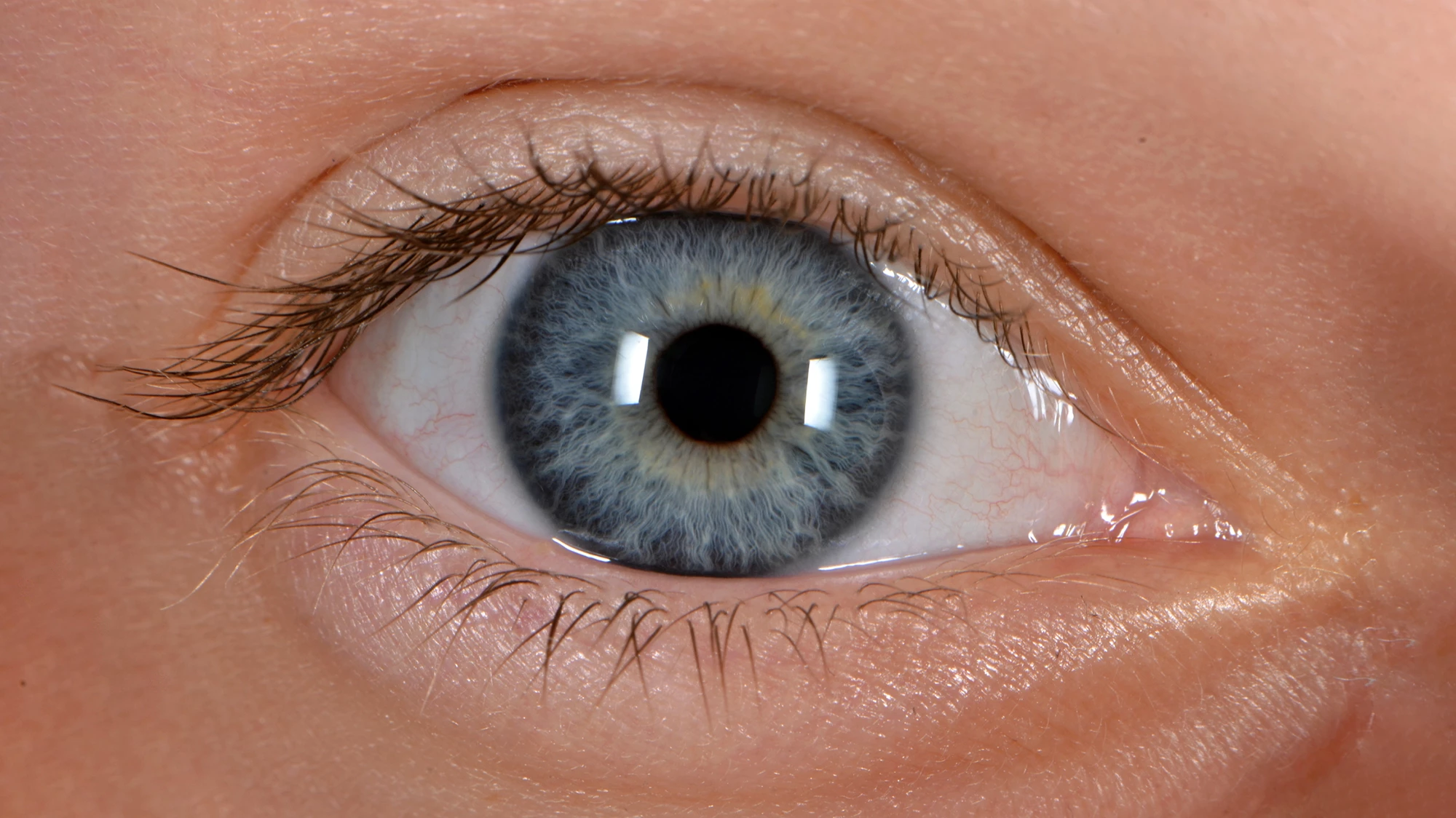 Elevated levels of 'good cholesterol' have been associated with a higher risk of glaucoma