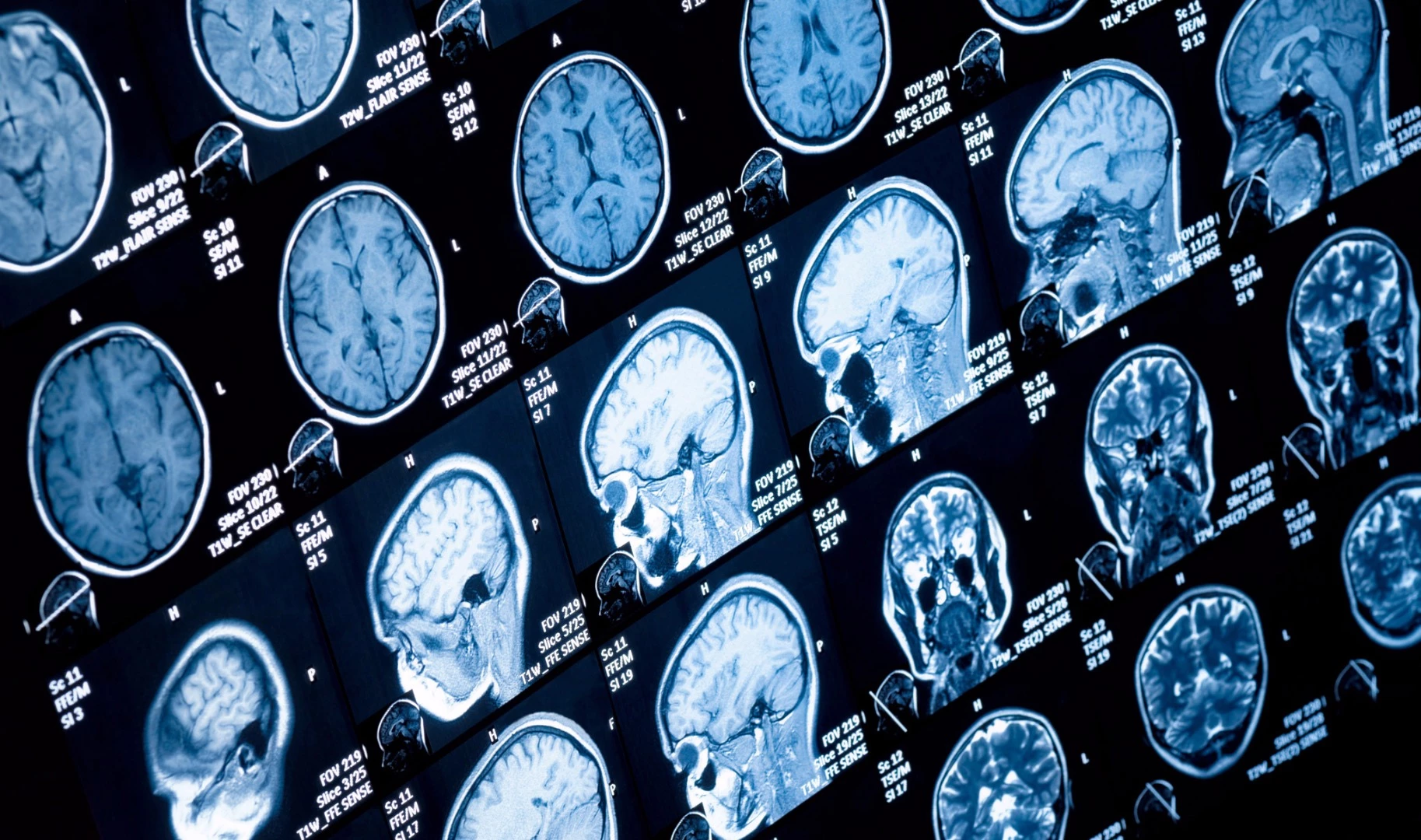 Scientists at Newcastle University discovered that a common form of fatal brain tumor feeds off of its fats by slowing its growth in mice with a drug that slows the production of fatty acids.