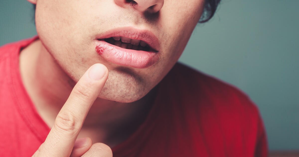 Molecule found that inhibits the spread of the cold sore virus Molecule found that inhibits the spread of the cold sore virus