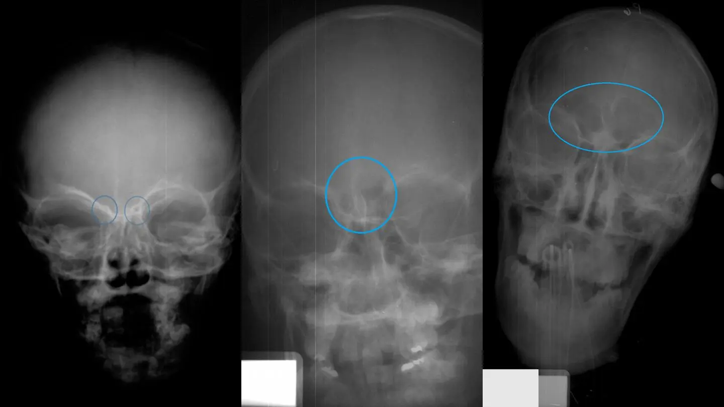 Skull X-rays of children in Stages 1, 2 and 3 of frontal sinus development