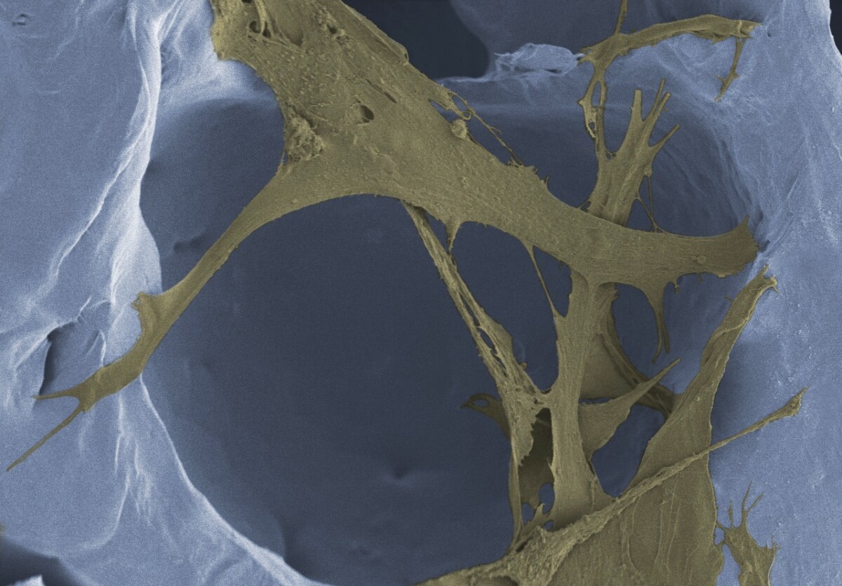 New skin tissue (brown) grows within the foam's polymer scaffolding (white)