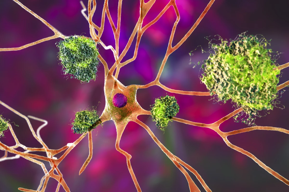 An artist's depiction of amyloid plaques surrounded by tau tangles, both considered key pathological signs of Alzheimer's disease