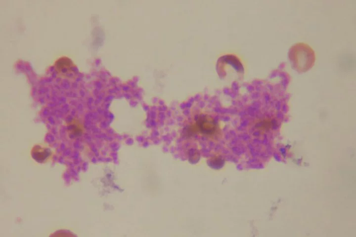 Natural platelets - seen here clumping from a blood smear - could soon get a helping hand from synthetic platelets (Image: Tieonardi via Wikimedia Commons)