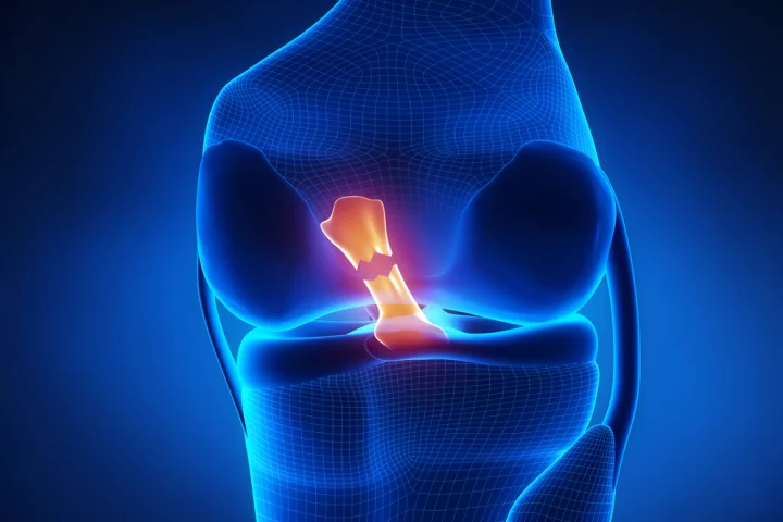 An illustration depicting a ruptured ACL (Image: Shutterstock)