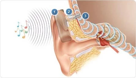 1. The sound processor 2. The connecting abutment that transfers the sound vibrations to the implant. 3. The titanium implant sends these vibrations directly to the cochlea.