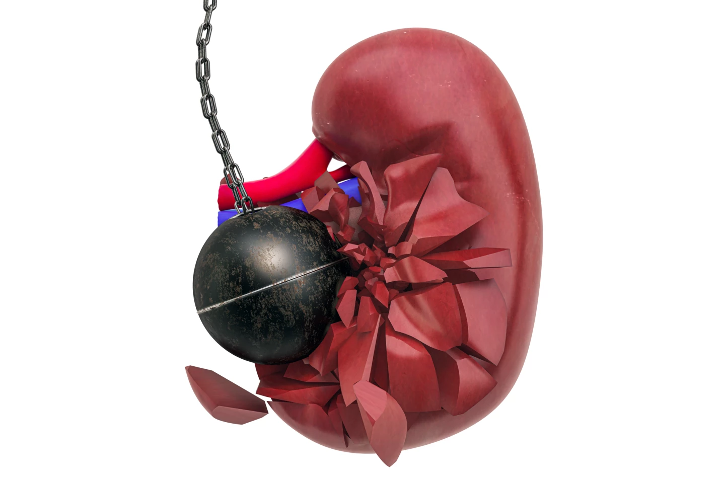 In chronic kidney disease, the kidney can't effectively filter waste and water out of the blood