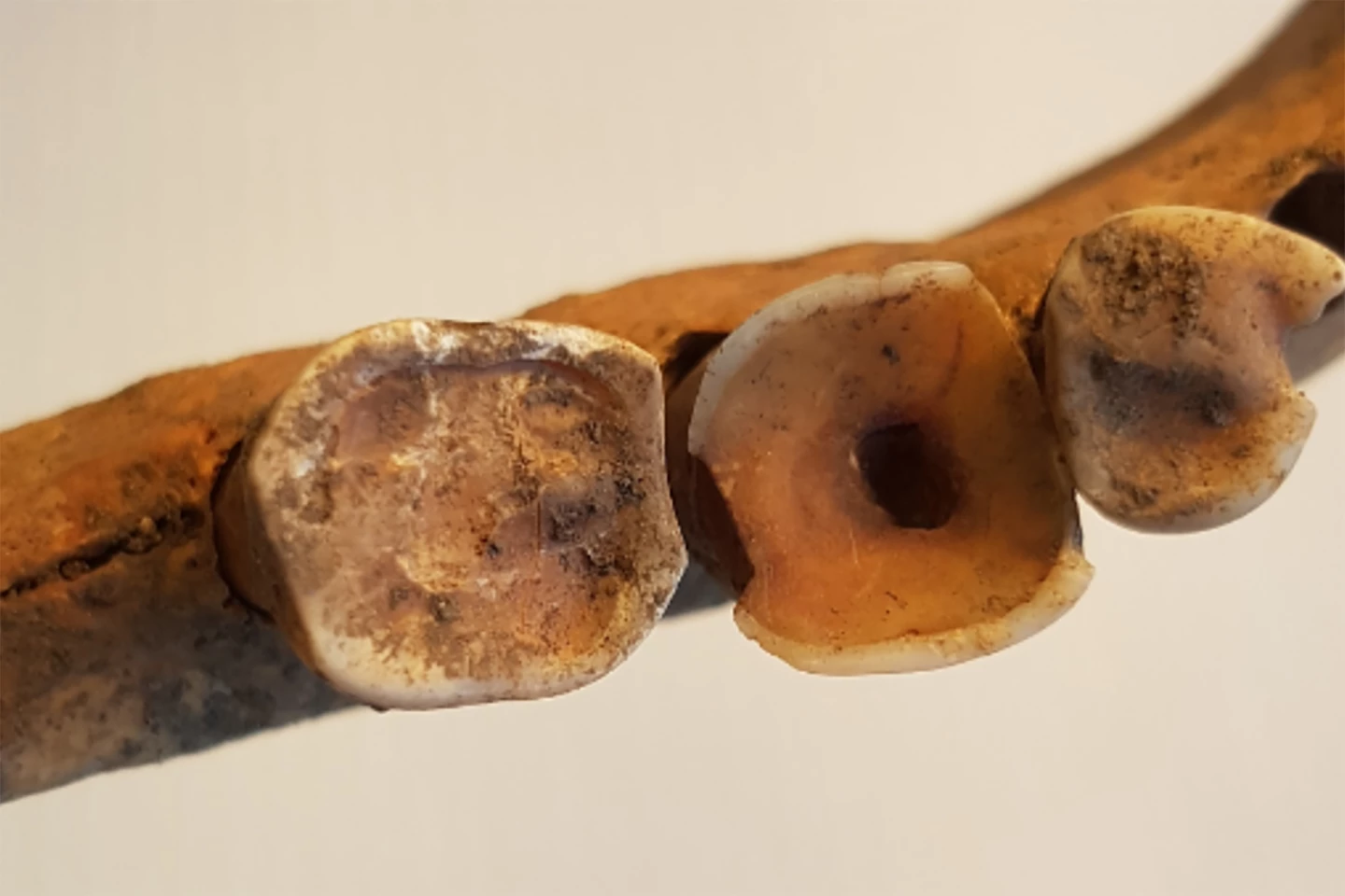 A filed hole from the crown of the tooth into the pulp to reduce toothache and infection