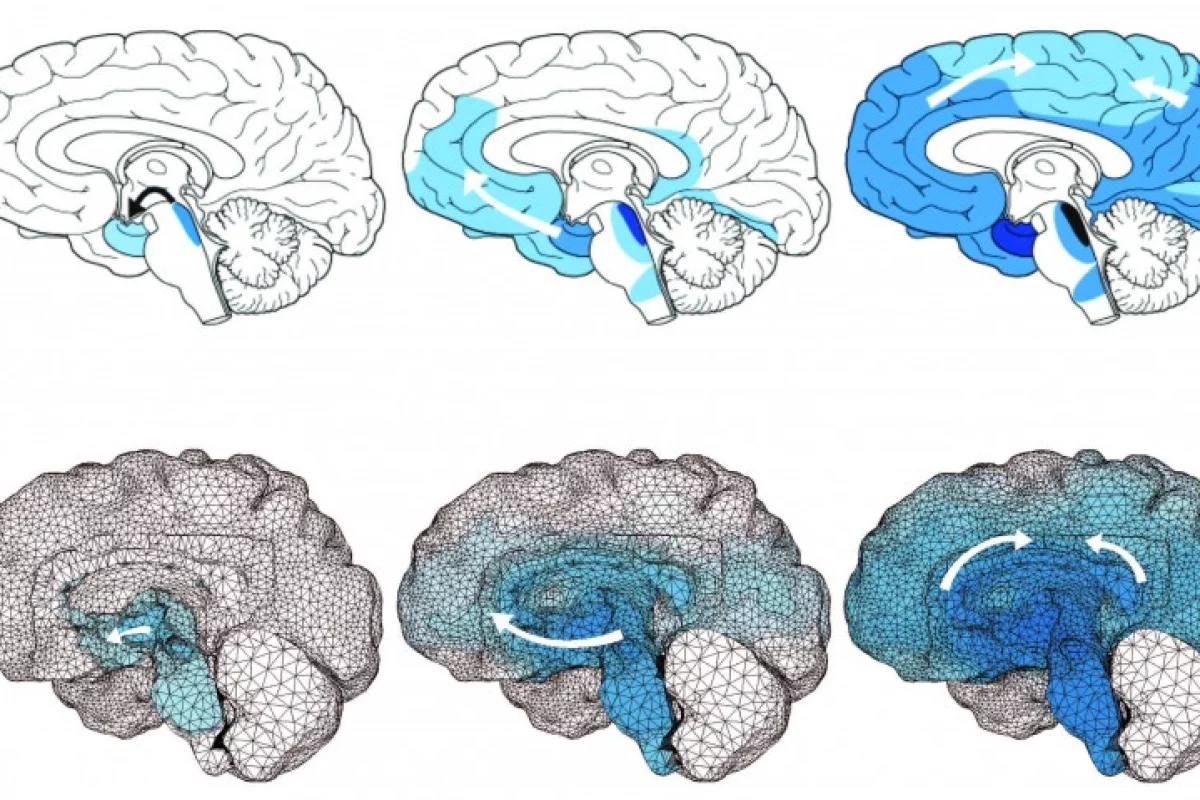 The above model shows how toxic tau proteins spread throughout the brains of patients with Alzheimer's disease