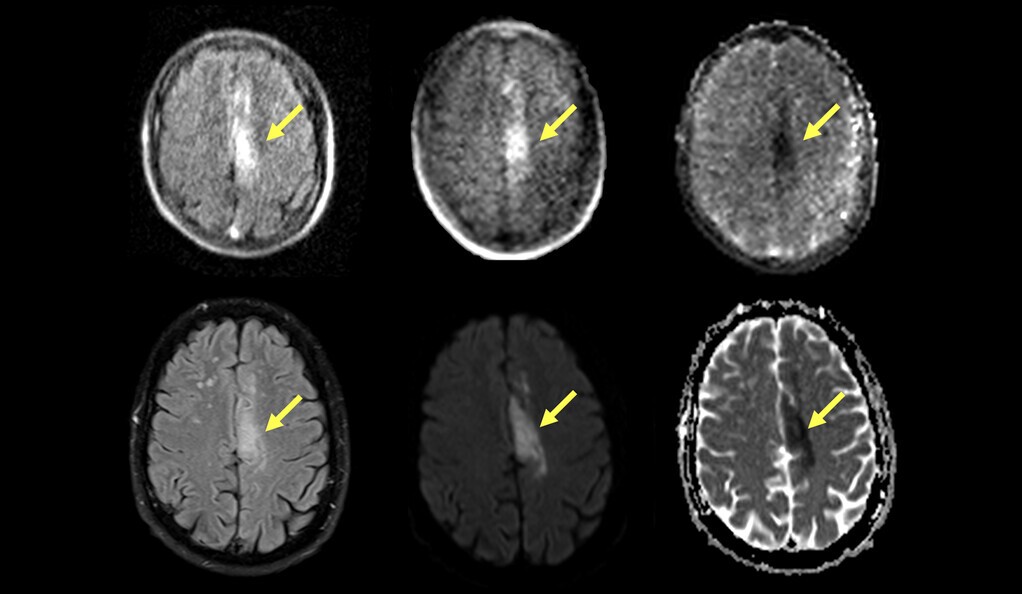 La resonancia magnética portátil (fila superior) puede detectar y caracterizar el accidente cerebrovascular isquémico identificado por resonancia magnética estándar (fila inferior)