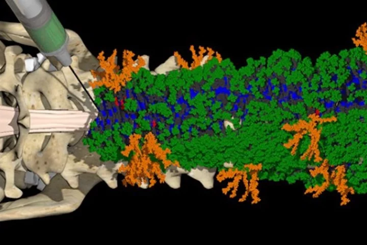 A molecular model of the new injectable nanofiber matrix containing clusters of two peptides (green and orange), which trigger cascading signals to repair spinal cord damage