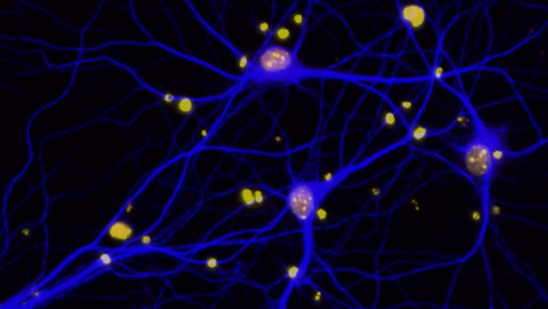 The study found that amyloid-beta plaques in the brain reduce levels on the protein BRCA1 (red) in neurons (blue)