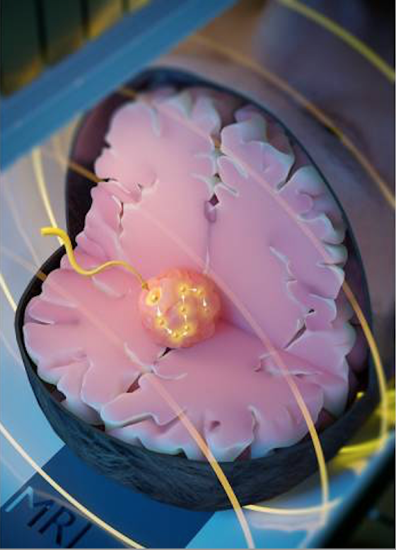 Artist's impression of a newly developed magnetic seed at the tumor site