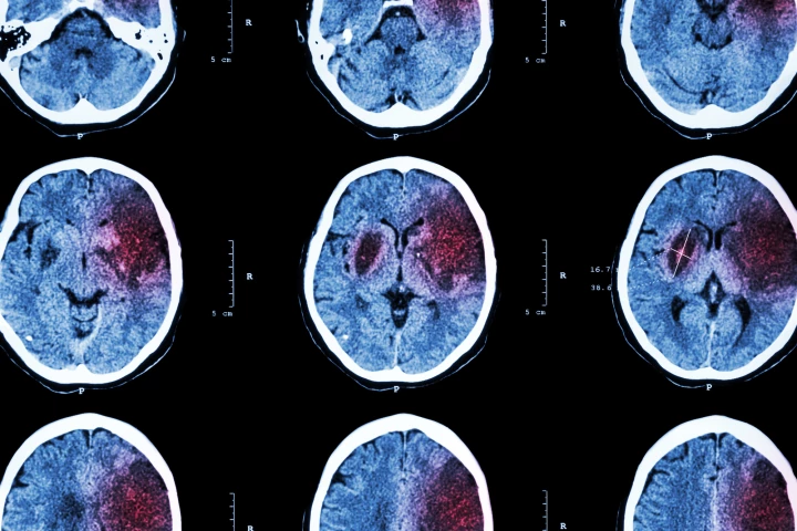 Researchers have used existing data to develop an accurate, sensitive model for predicting stroke