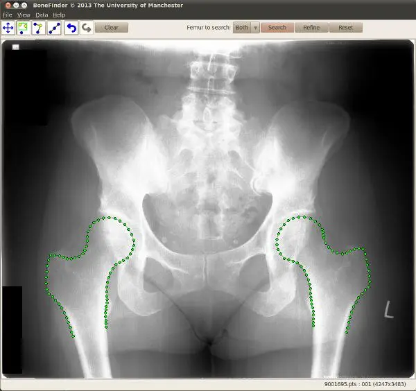 An x-ray displaying BoneFinder-enhanced hip bones