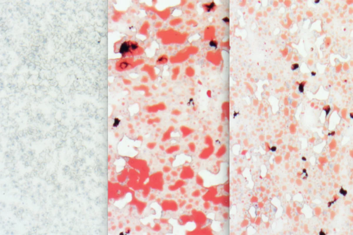 A comparison of the livers of different groups of mice – left is a healthy mouse liver, middle shows the fatty deposits (red) left by a high-fat/cholesterol diet over 12 weeks, and the right image shows that same high-fat diet in mice with high levels of Aloxe3 expression