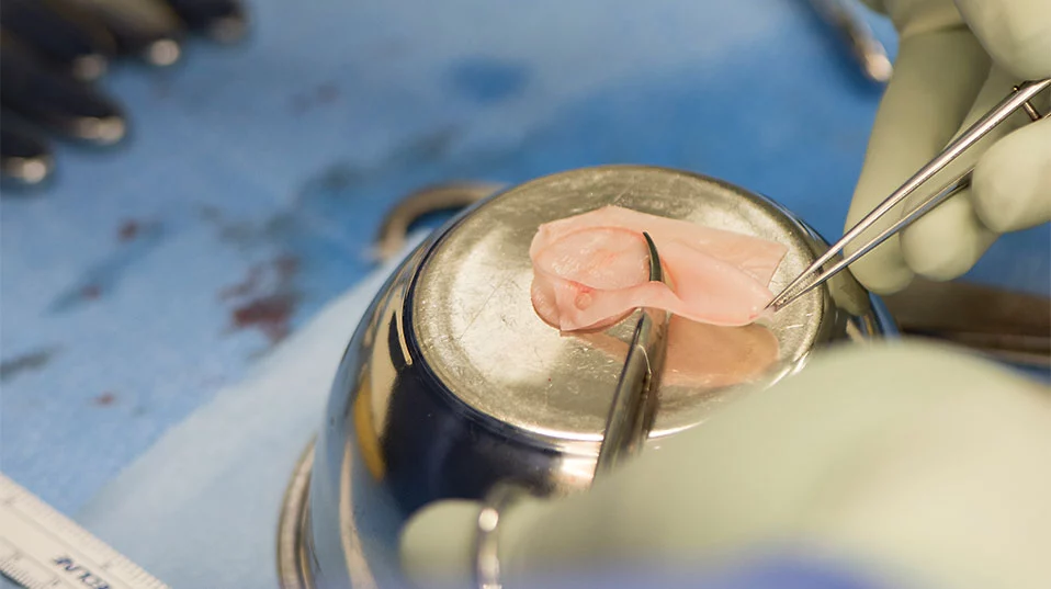 A graft formed from cultured nasal cartilage cells, ready for implantation