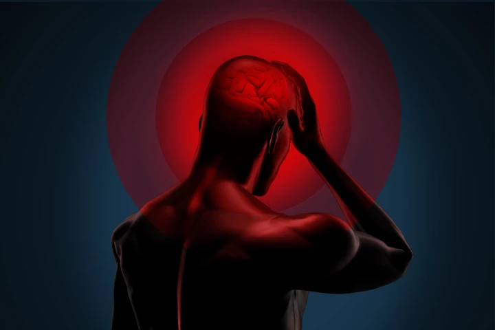 A small implant in the back of the head delivers electrical stimulation to the occipital nerve, reducing the frequency and severity of attacks in patients with chronic cluster headache