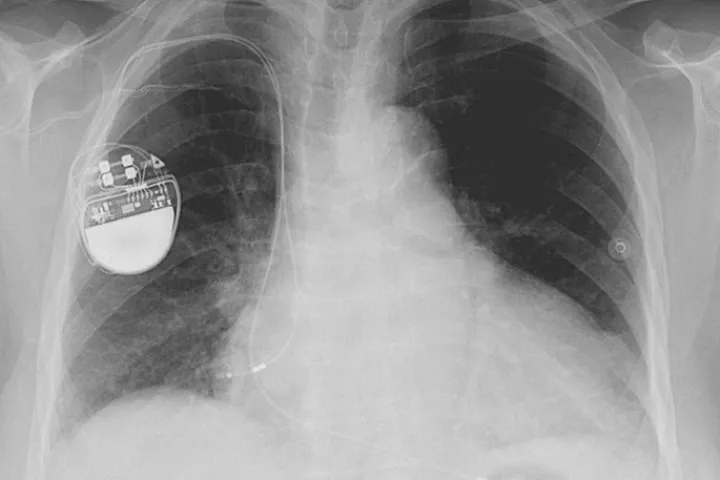 Scientists from MIT are designing a wearable signal jamming system, to protect implantable medical devices (such as this pacemaker) from wireless attacks (Image: Lucien Monfils)