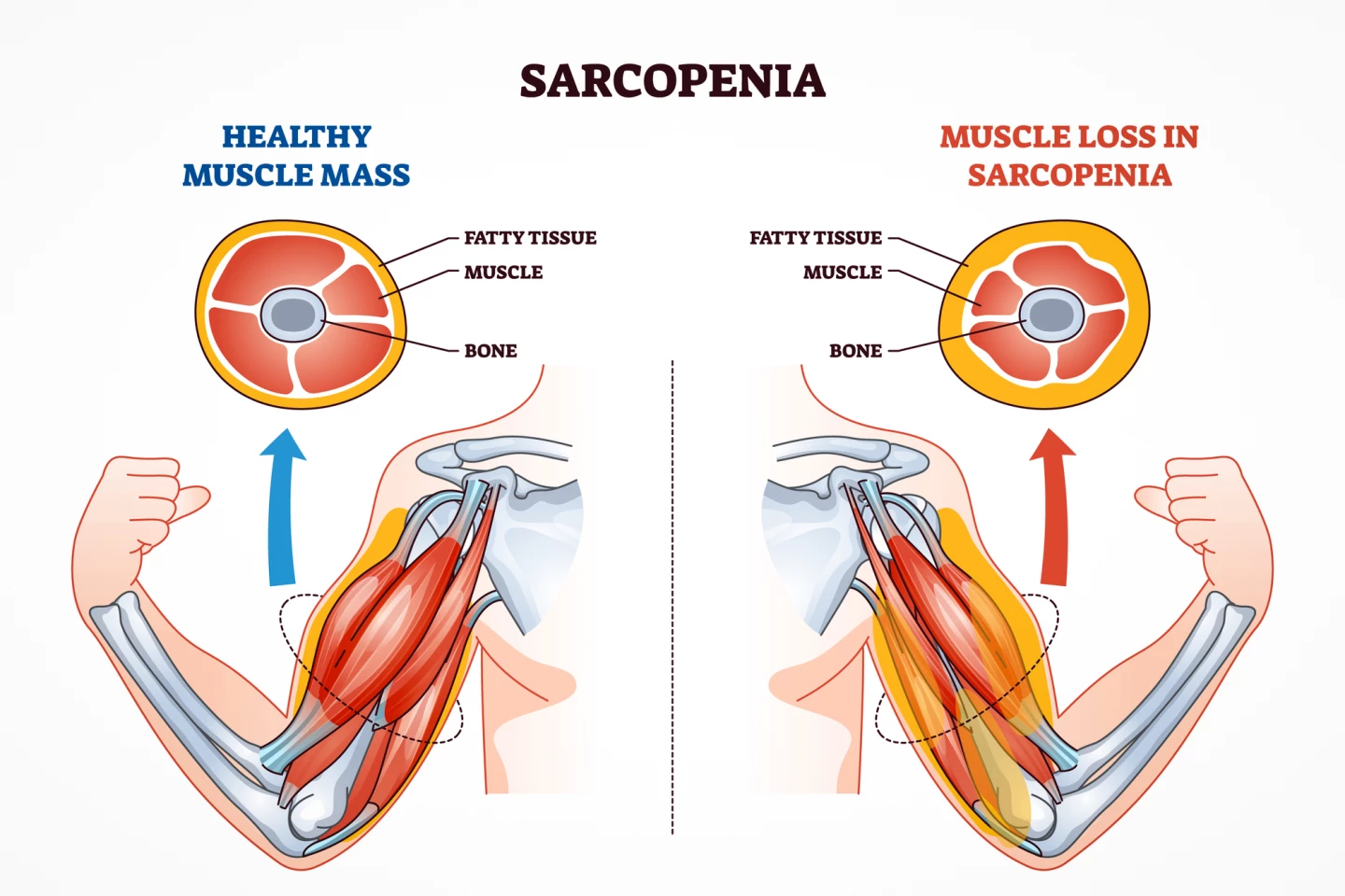 Sarcopenia, the loss of muscle mass and strength, occurs with aging