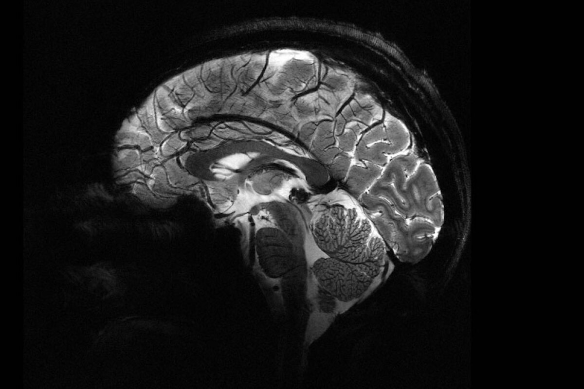 An image of a human brain captured with the new Iseult MRI machine at a power of 11.7 Teslas, showing the level of detail possible