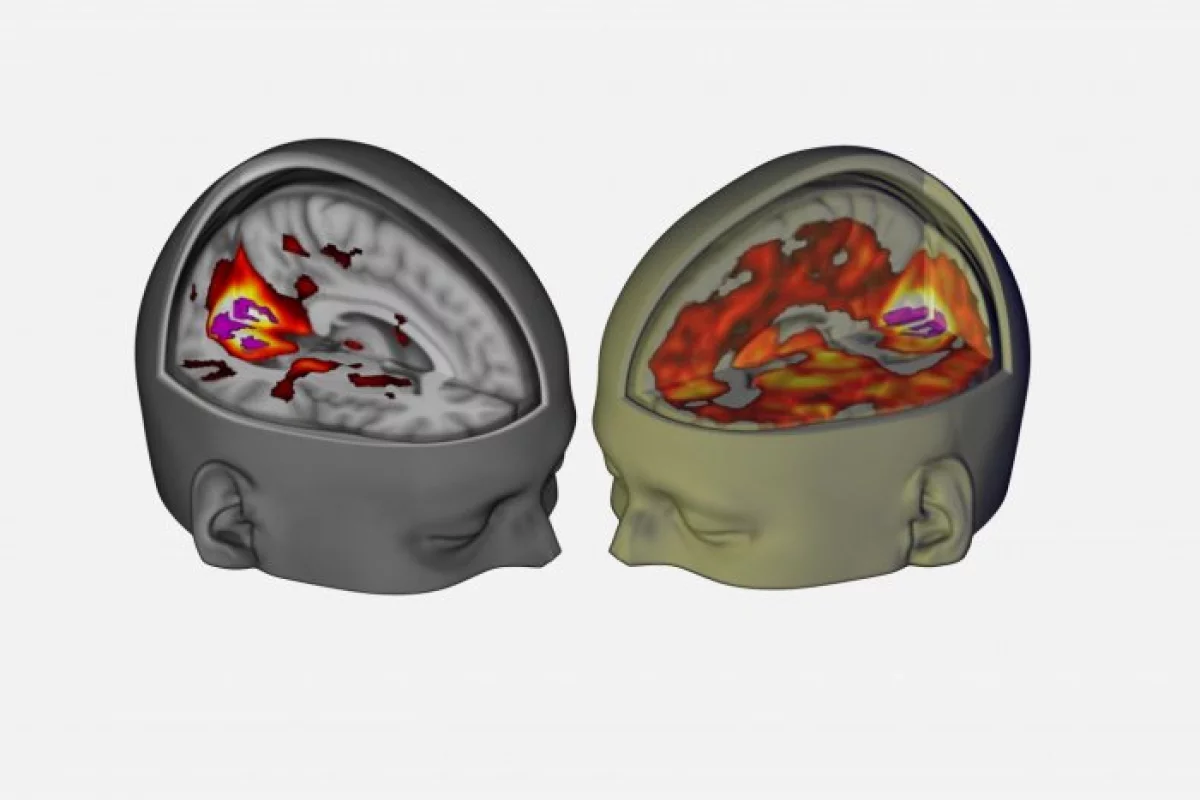 The brain image on the right shows the increase of brain areas contributing to visual processing under LSD, compared with the brain on the left under normal circumstances