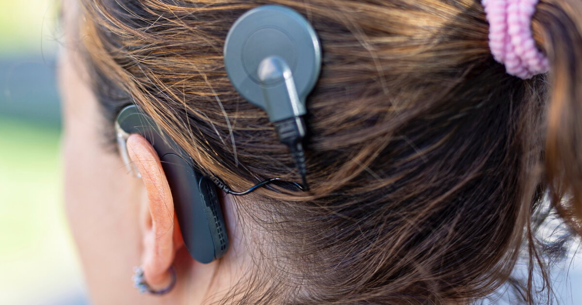 Mic Inhaller Implantable mic says sayonara to external cochlear implant hardware