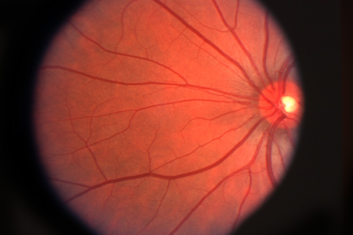 Spanish scientists have created a "biohybrid" artificial retina as a potential treatment for macular degeneration