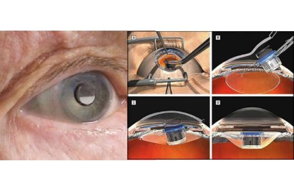 Eye telescope gets FDA approval