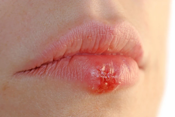 Infection with the herpes simplex virus was found to double dementia risk in older adults