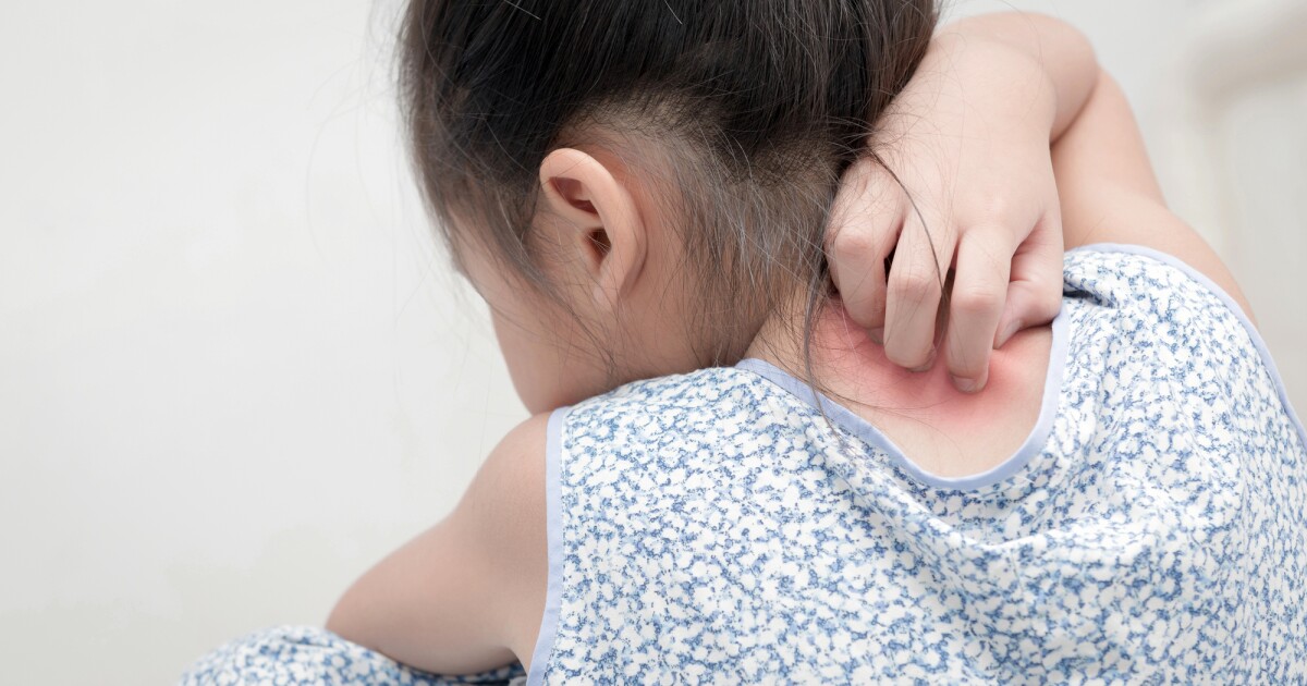 Triclosan exposure linked to allergies in children Triclosan exposure linked to allergies in children