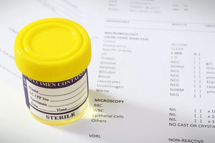 The US Irvine team says that a new approach using a urine sample can greatly cut the resources and time needed to screen for the hepatitis C virus