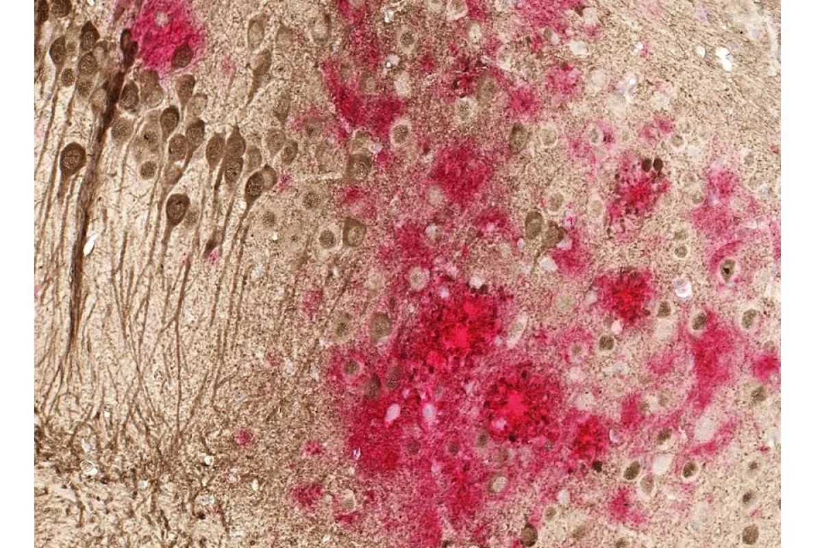 After success in three separate animal models an Alzheimer's vaccine is on the cusp of human trials. Toxic amyloid plaques (red) and tau tangles (brown) form on the brain of a mouse modeled to have the disease. A study shows a DNA vaccine reduces both amyloid and tau in the mouse AD model, with no adverse immune responses