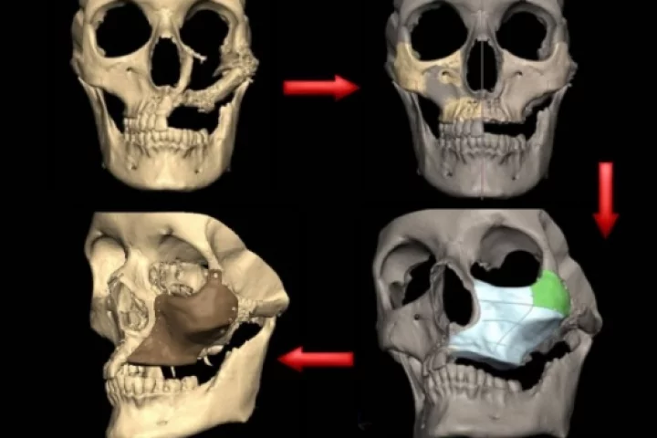 S. Bell: the process of rebuilding a damaged face using engineering-assisted surgery