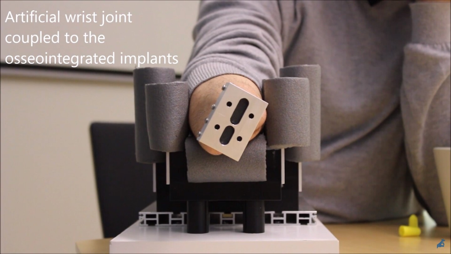 The artificial wrist joint seen attached to the osseointegrated implants