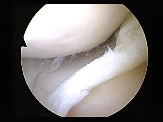 A new type of stem-cell-seeded bandage, designed to heal torn meniscal cartilage such as that pictured above, has been approved for a clinical trial in the UK (Photo: Arthroscopist)