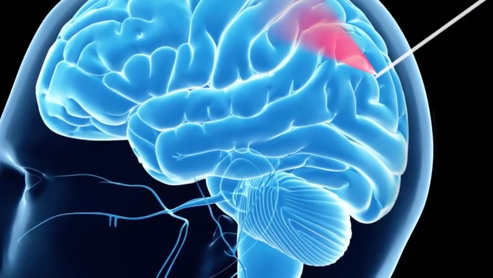 The researchers say this is the first time in the world that this technology has been used on humans