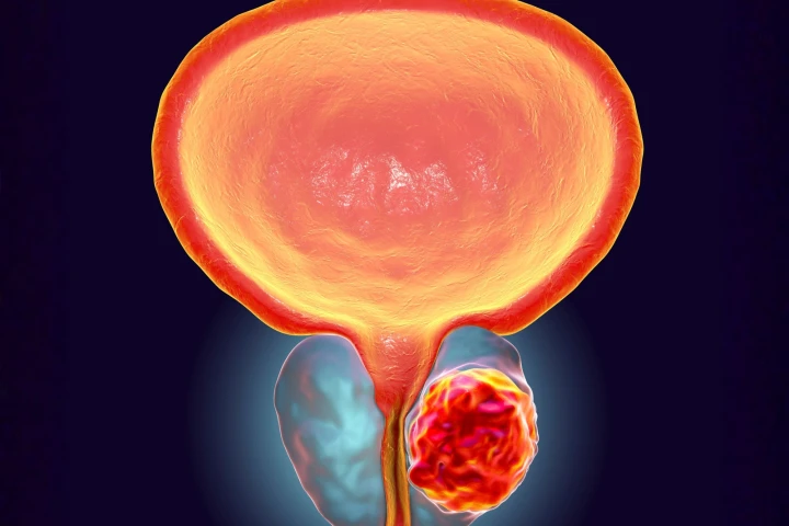 Illustration of a prostate