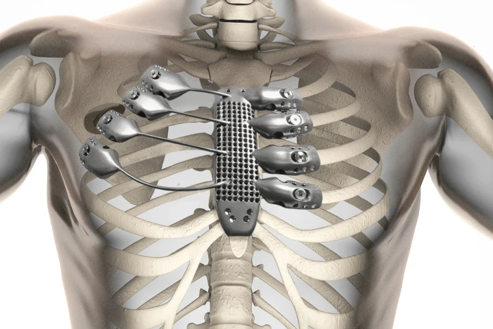 3D printing technology has enabled a replacement sternum and rib cage customized for a specific patient