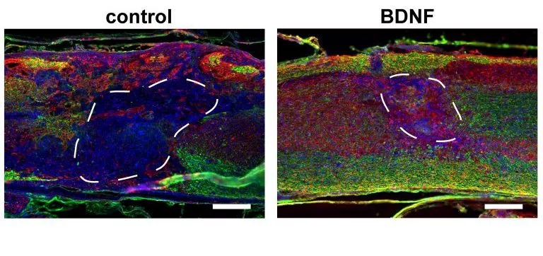 Eight weeks after injection, the injury sites are recovering at different rates. Left: mice injected with a control scaffold. Right: mice injected with a scaffold containing gene therapy vectors, improving the numbers of axons (red) and myelinating glial cells (green)