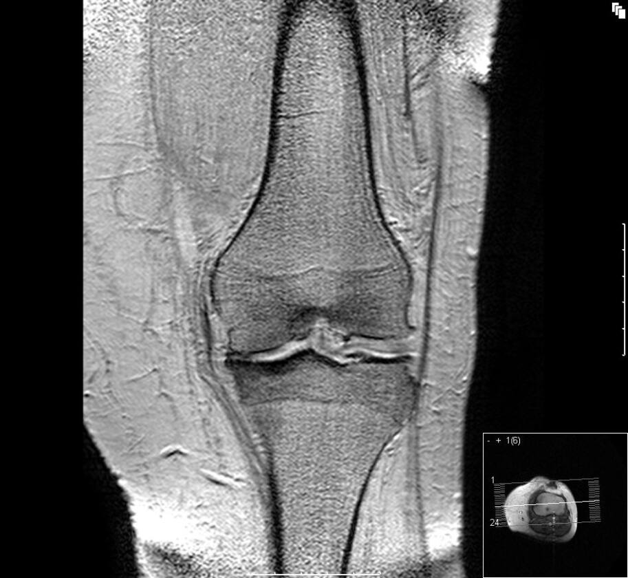 Osteoarthritis of the knee, showing the reduction of bone-cushioning cartilage on the left (Image: Scuba-limp)