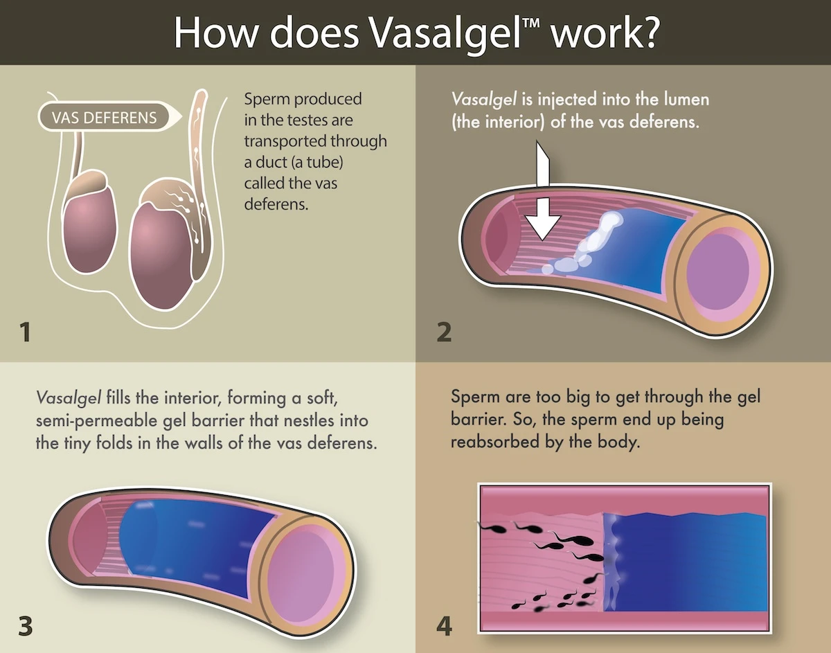 Vasalgel works by forming a barrier inside the tube that transports sperm from the testicle