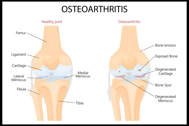 Knee Osteoarthritis Injection Eases Pain by 58% and Regenerates Cartilage ?url=http%3A%2F%2Fnewatlas Brightspot.s3.amazonaws.com%2F61%2Fdc%2F672f79b14504b9ab9f783df2bd49%2Fdepositphotos 604468952 L