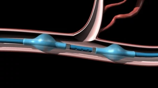 The IsoFlow Isolation Catheter in action.