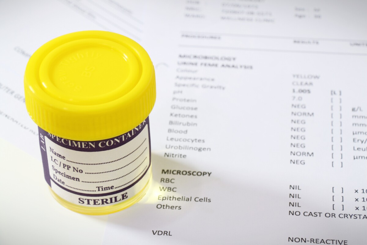 Onestep urine test to simplify diagnosis of hepatitis C