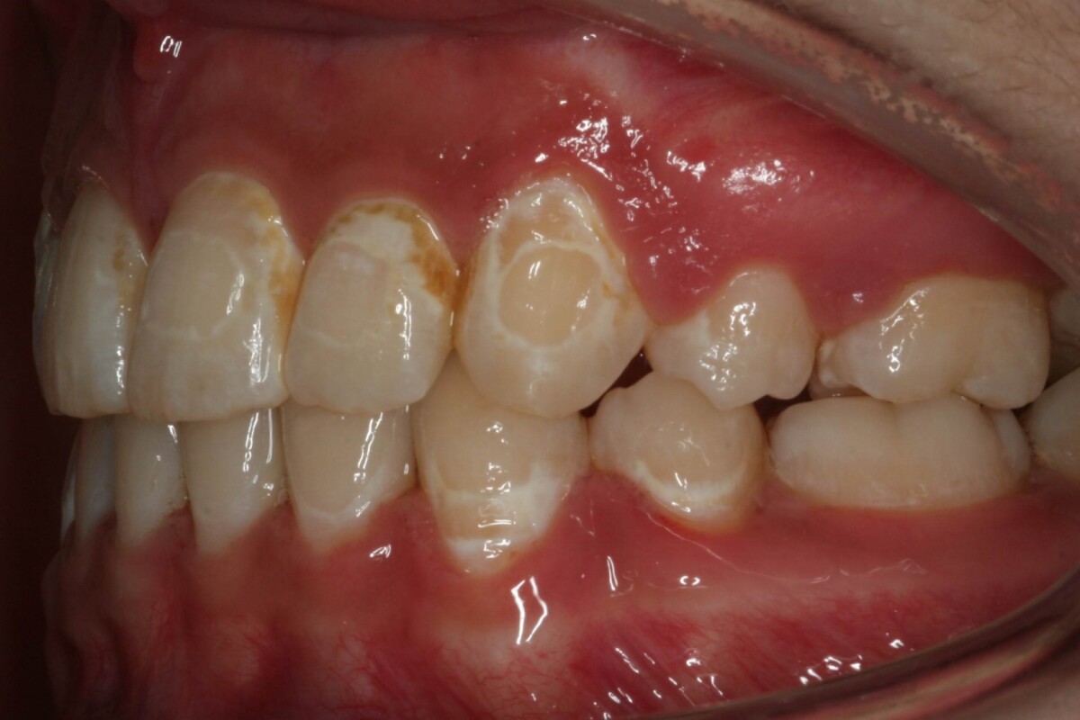 White spot lesions on the teeth of a person who previously wore braces