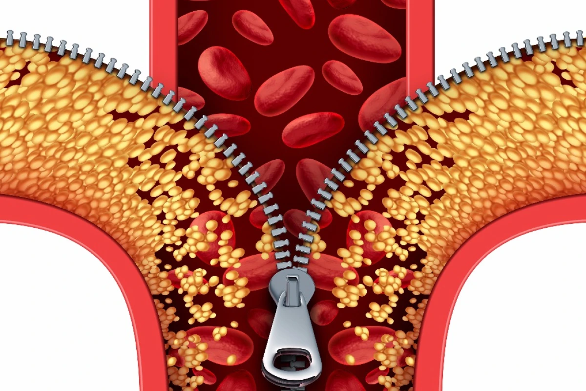 Scientists have discovered that a cancer drug can also combat fatty arteries by reducing inflammation and mimicking exercise