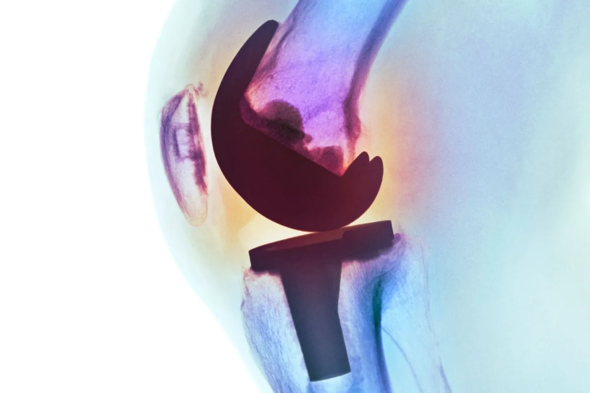 Particles from total joint replacements can enter the brain, but don't ...