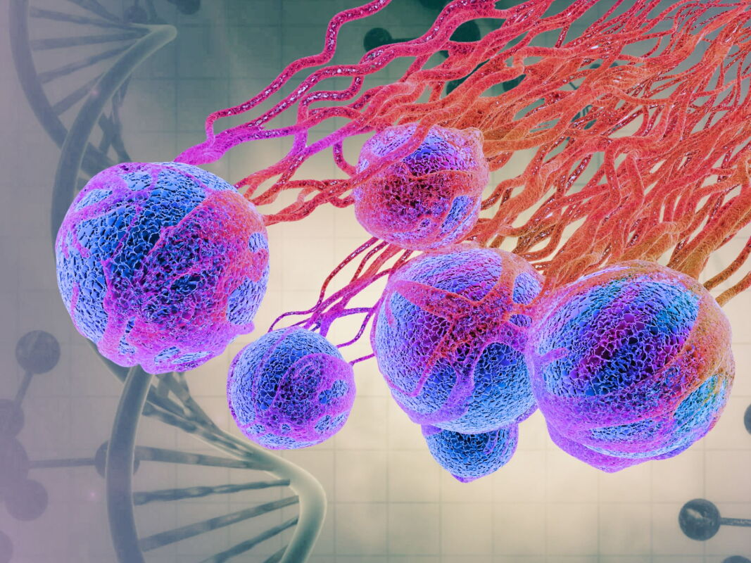 Landmark melanoma vaccine cuts deaths in landmark trial